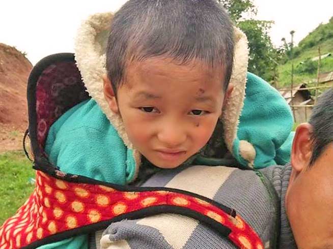 A Kachin Christian child, scarred and nearly blinded by shrapnel